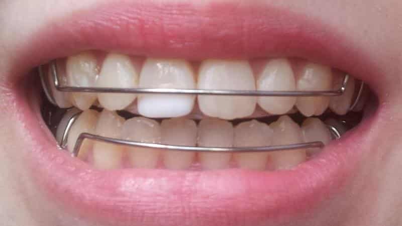 ортодонтичні пластинки для вирівнювання зубів