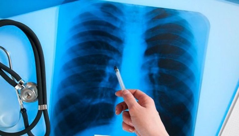 На Хмельниччині чоловіків хворих на туберкульоз у 2,5 разів більше, ніж жінок