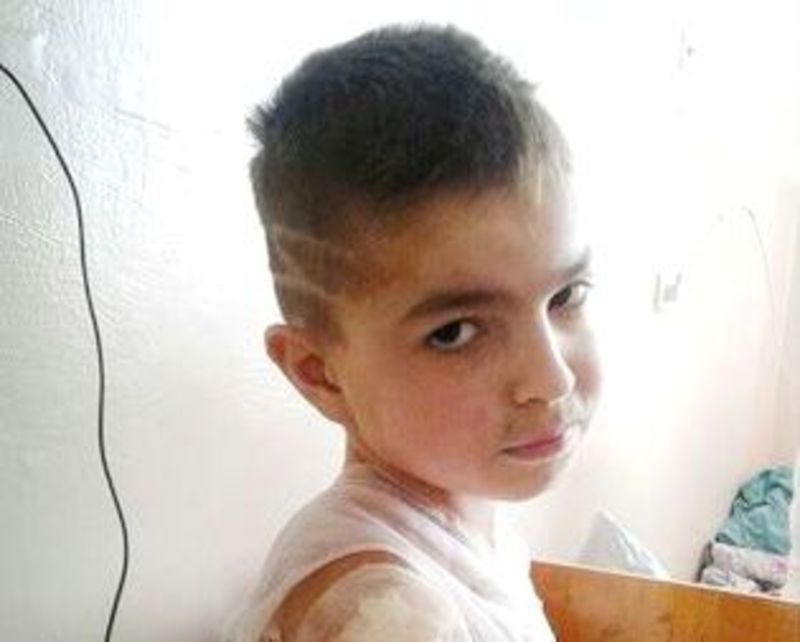 На реабілітацію хлопчика, який постраждав від вогню, потрібно 22 тисячі гривень